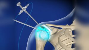 عمل جراحی آرتروسکوپی: گامی نوین در دنیای درمان 6 diagnosticarthroshoulder_1280